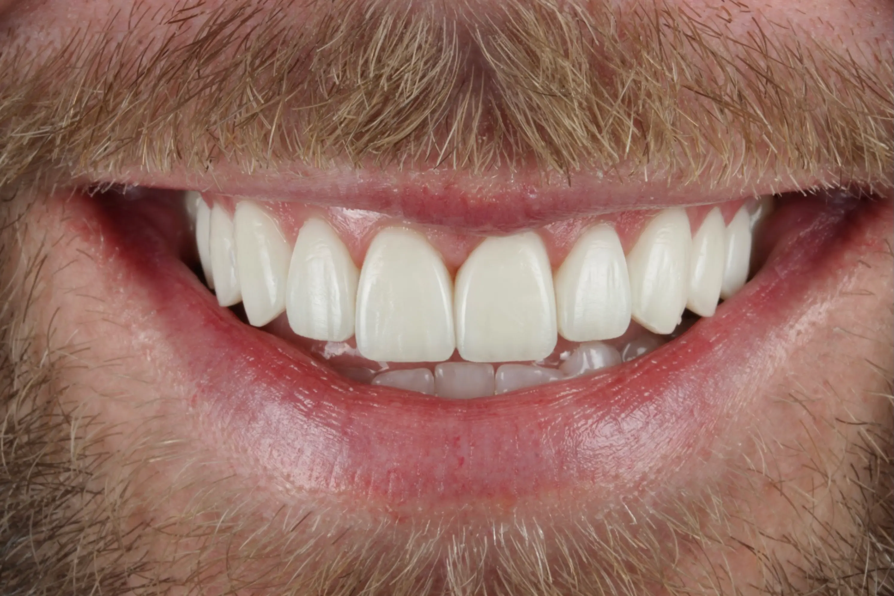 teeth-straightening-Invisalign