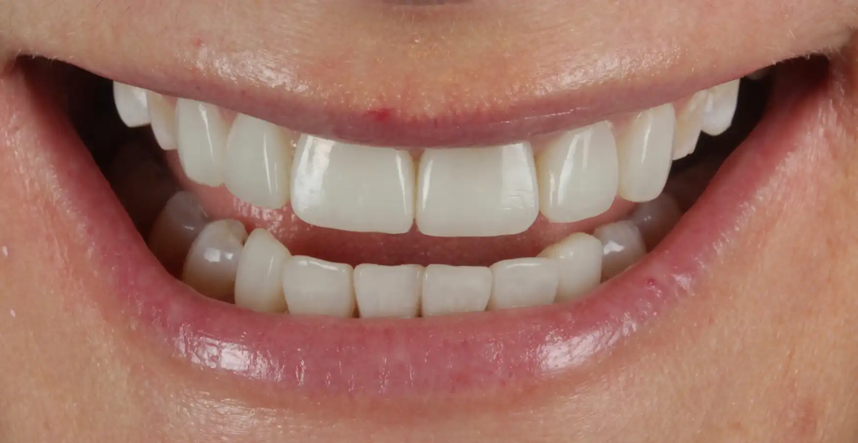 teeth-Whitening
